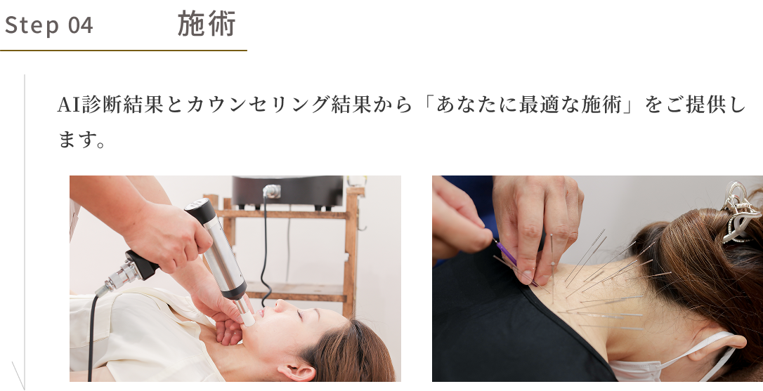 step04 施術　AI診断結果とカウンセリング結果から「あなたに最適な施術」をご提供します。